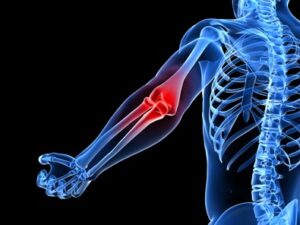 Golfer's elbow in Coventry and the Midlands