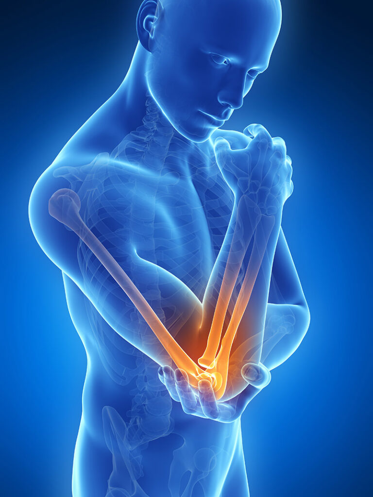 Tennis elbow pain in Coventry and the Midlands