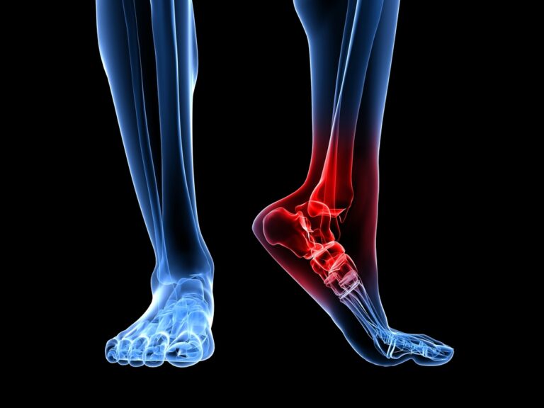 Lower Extremity Basketball Injuries - Florida